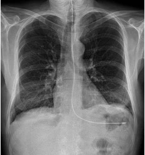 <p><span>weighted tip at least 10cm past the gastro-esophageal junction = 10 cm below the diaphragm and overlying the gastric bubble</span></p>