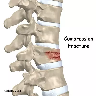 <p>A compression fracture occurs when a bone, usually a vertebra, is crushed or collapsed, often from osteoporosis or trauma.</p>