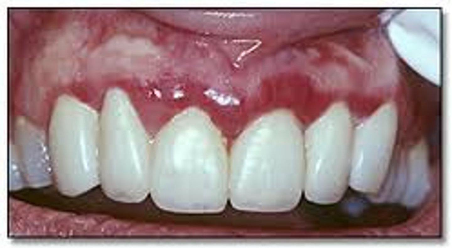 <p>red and swollen</p><p>brushing teeth too often</p>
