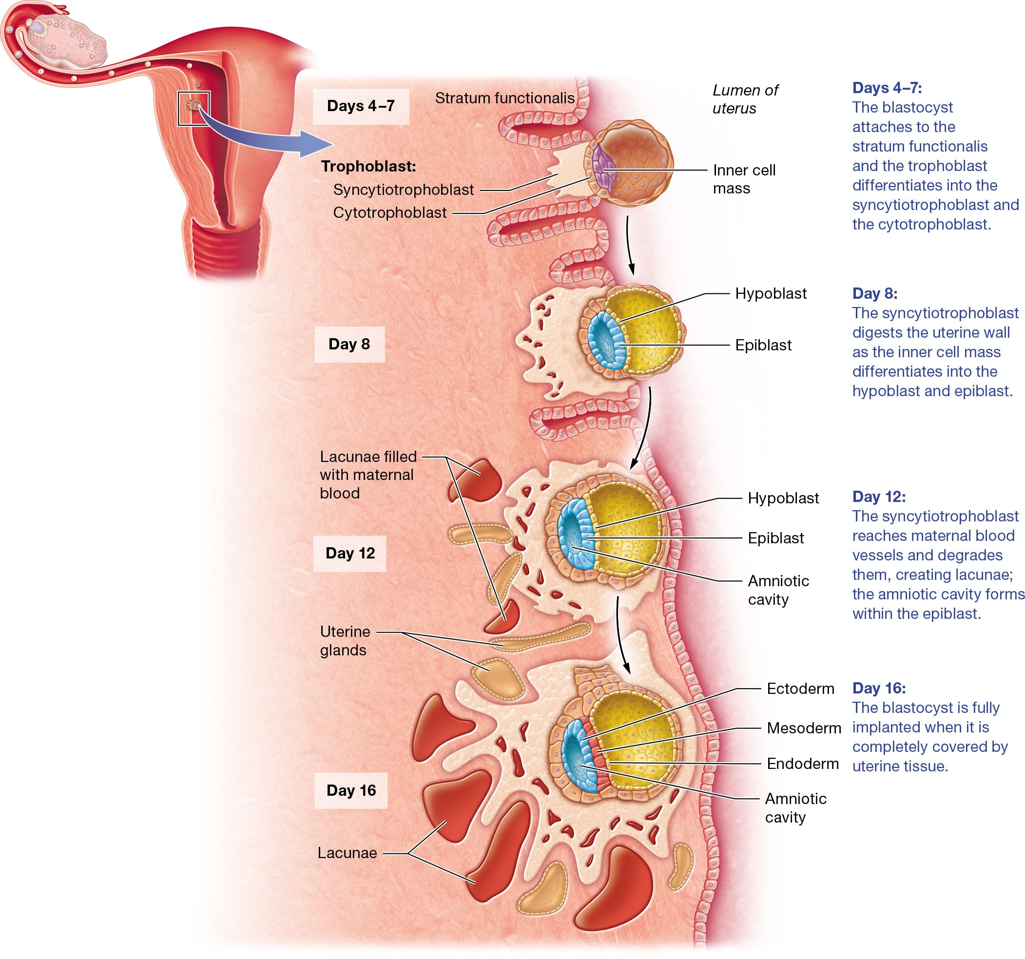 <p><strong>Embryo Implantation Process</strong></p><ul><li><p><strong>Days 4–7:</strong> The blastocyst attaches to the uterine lining, specifically the stratum functionalis. The trophoblast differentiates into two layers: syncytiotrophoblast and cytotrophoblast. The syncytiotrophoblast begins to digest the uterine wall, facilitating deeper implantation.</p></li><li><p><strong>Day 8:</strong> The inner cell mass of the blastocyst differentiates into the hypoblast and epiblast, forming the foundation for future embryonic development.</p></li><li><p><strong>Day 12:</strong> The syncytiotrophoblast reaches maternal blood vessels, creating lacunae filled with maternal blood. This supports nutrient exchange.</p></li><li><p><strong>Day 16:</strong> The blastocyst is fully implanted and covered by uterine tissue. Three germ layers—ectoderm, mesoderm, and endoderm—form, setting the stage for organ development.</p></li></ul><p><strong>Uterine Lining Changes</strong></p><ul><li><p>The syncytiotrophoblast secretes human chorionic gonadotropin (hCG), maintaining the corpus luteum to continue estrogen and progesterone secretion. This prevents menstruation and supports the uterine lining's growth and development.</p></li></ul><p></p>