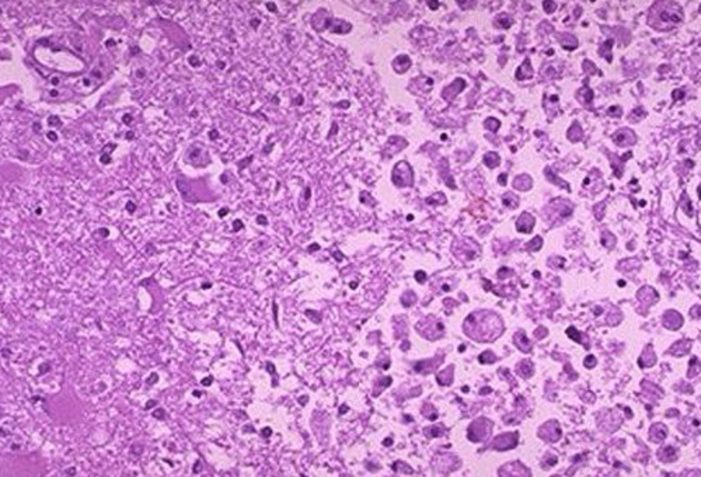 <p>What kind of necrosis is shown?</p>