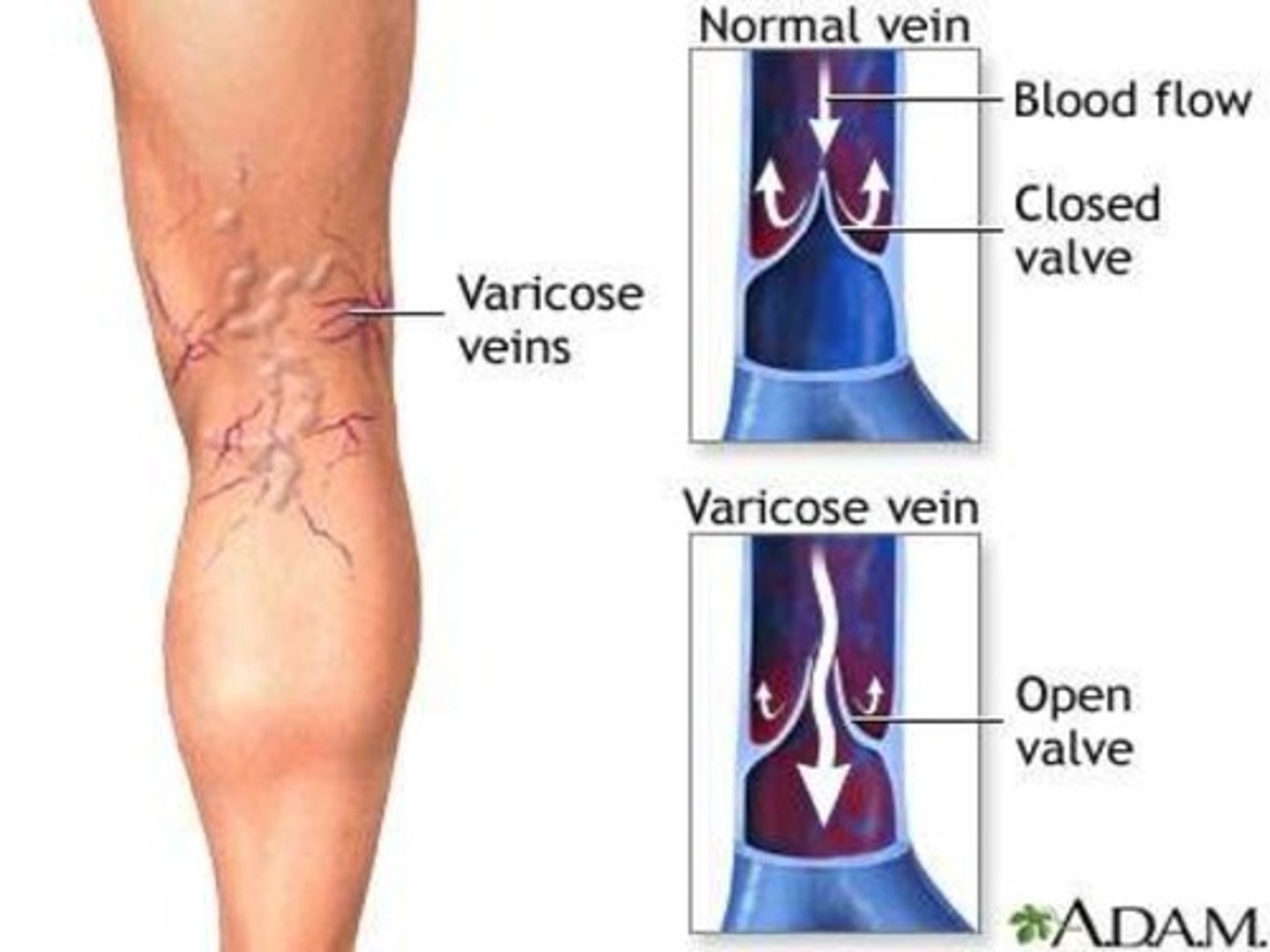 <p>venous blood is pushed back into organs == dilates veins-> varicose</p>