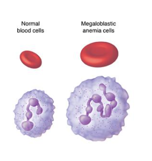 <p>causes anemia</p><ul><li><p>blood cells require cobalamin for proliferation</p></li><li><p>low cobalamin levels cause:</p><ul><li><p>enlarged RBCs</p></li><li><p>nuclear hypersegmentation of DNA in neutrophils</p></li></ul></li></ul><p></p>