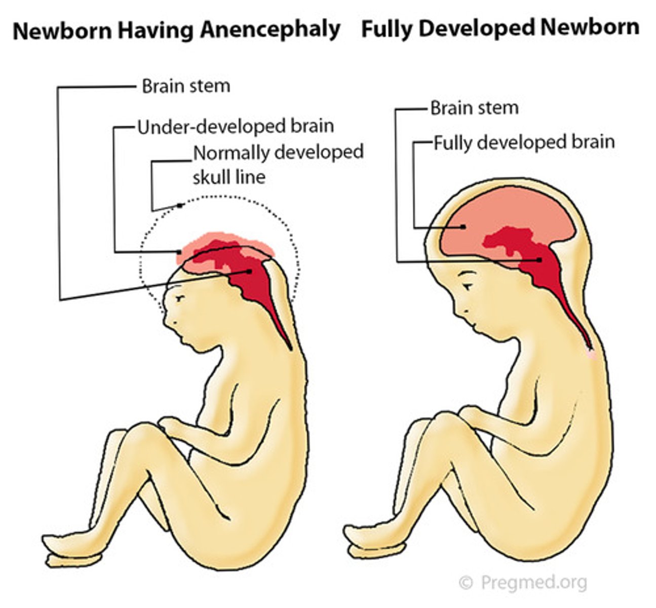<p>If fetus with exencephaly survives, there is degeneration of the brain to a spongiform mass with no bony covering; incompatible with life usually beyond a few days</p>