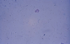 Bacteria acccompanied by a WBC