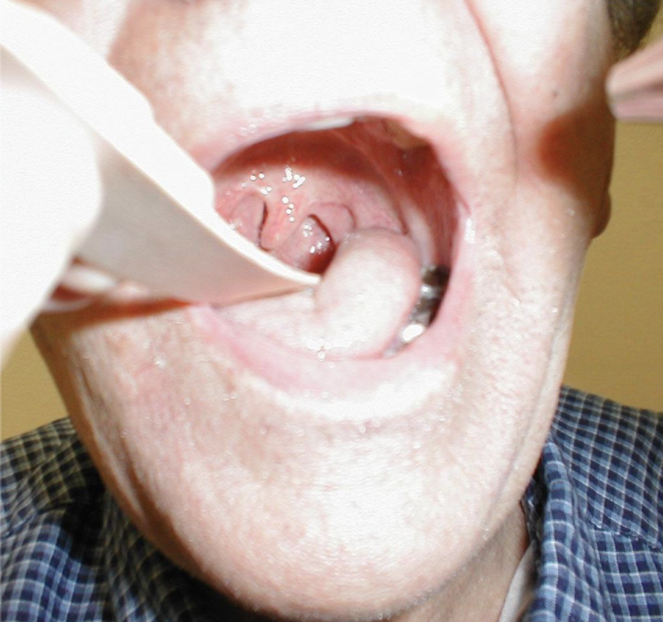 <p>uvula pulled over towards right (often in post-stroke patients but other processes can cause deviation as well like peritonsilar abscess)</p>