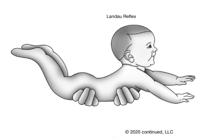 <ul><li><p><strong>stimulus: </strong>hold infant in horizontal prone suspension</p></li><li><p><strong>response: </strong>complete extension of head, trunk, and extremities</p></li><li><p><strong>fxn sig:</strong></p><ul><li><p>regulates tone</p></li><li><p>promotes prone extension to manage flexor tone</p></li></ul></li><li><p><strong>onset age: </strong>3-4 mos</p></li><li><p><strong>integration: </strong>12-24 mos</p></li><li><p><strong>real EX:</strong> lifting baby in air over head to play and they have extremities ext</p></li></ul><p></p>