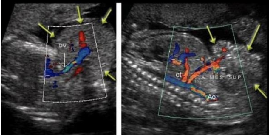 <p>a solid mass is attached to the ventral wall of a 22w fetus. there is no abd wall or fetal skin covering the mass, but the abd vasculature appears to be shared between the fetus and the mass</p><p>a) parasitic conjoined twins</p><p>b) gastroschisis</p><p>c) omphalocele</p><p>d) prune belly syndrome </p>