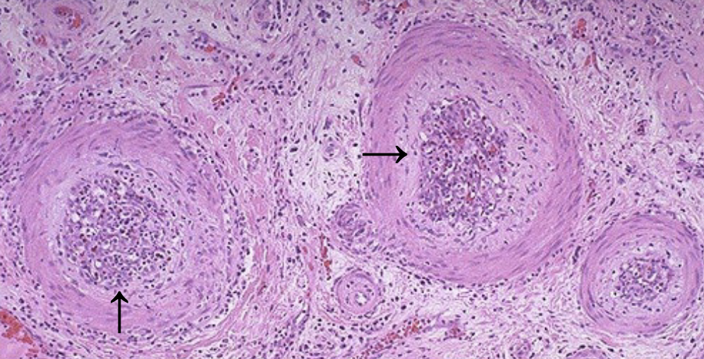 <p>A 48-year-old female with late stage chronic renal failure from diabetes undergoes renal transplantation. Urine production is adequate post- operatively. 8 months later for a follow-up visit, she has a BUN/Cre level well above normal and complains of decreased urine production with symptoms of headache and back pain. A biopsy reveals what is shown on the next slide. What is the pathogenesis of this condition? </p><p>A. Damage due to infiltrating neutrophils &amp; basophils</p><p>B. Damage due to infiltrating dendritic cells </p><p>C. Damage due to infiltrating T cells &amp; macrophages </p><p>D. Damage due to binding of IgA + complement</p>