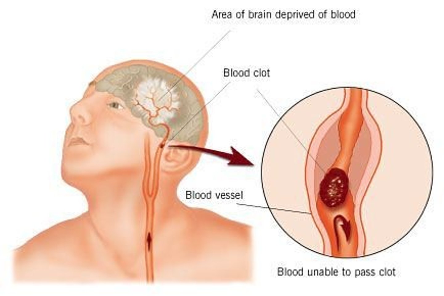 <p>normal blood flow to brain is stopped either by blockage or rupture of blood vessel causing death of brain tissue</p>