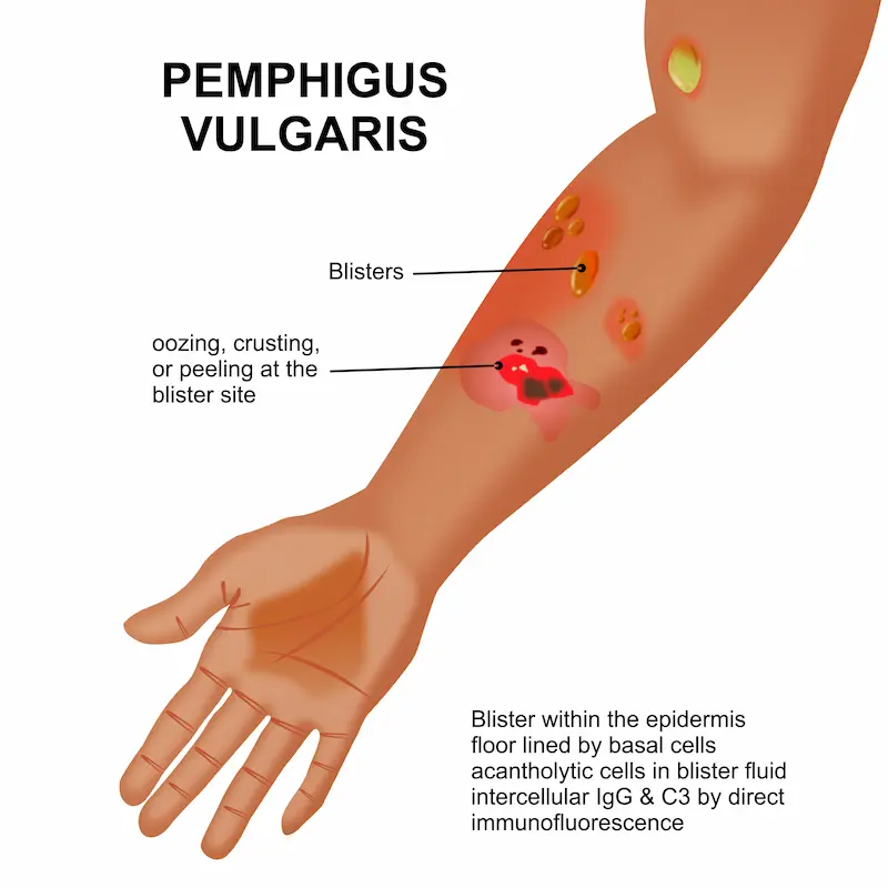<p>PP: <span><span>chronic autoimmune disorder</span></span><br><span><span>appear first in mouth+malodorous</span></span></p><p>E: unknown</p><p>CM: mucosal erosions<br>thin-walled bullae<br>easily rupture→crusts→hyperpigmented patches+no scarring</p><p>DX:<br><u>nikolsky sign:</u><br>push blister→further separation of the dermis</p><p><u>paraneoplastic:</u><br>non-hodgkin lymphoma<br>chronic lymphocytic leukemia<br>sarcoma</p><p>TX: high-dose PO prednisone</p><p>P: paraneoplastic→death from underlying cancer</p>