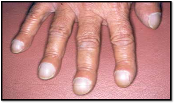 <p>COPD</p>