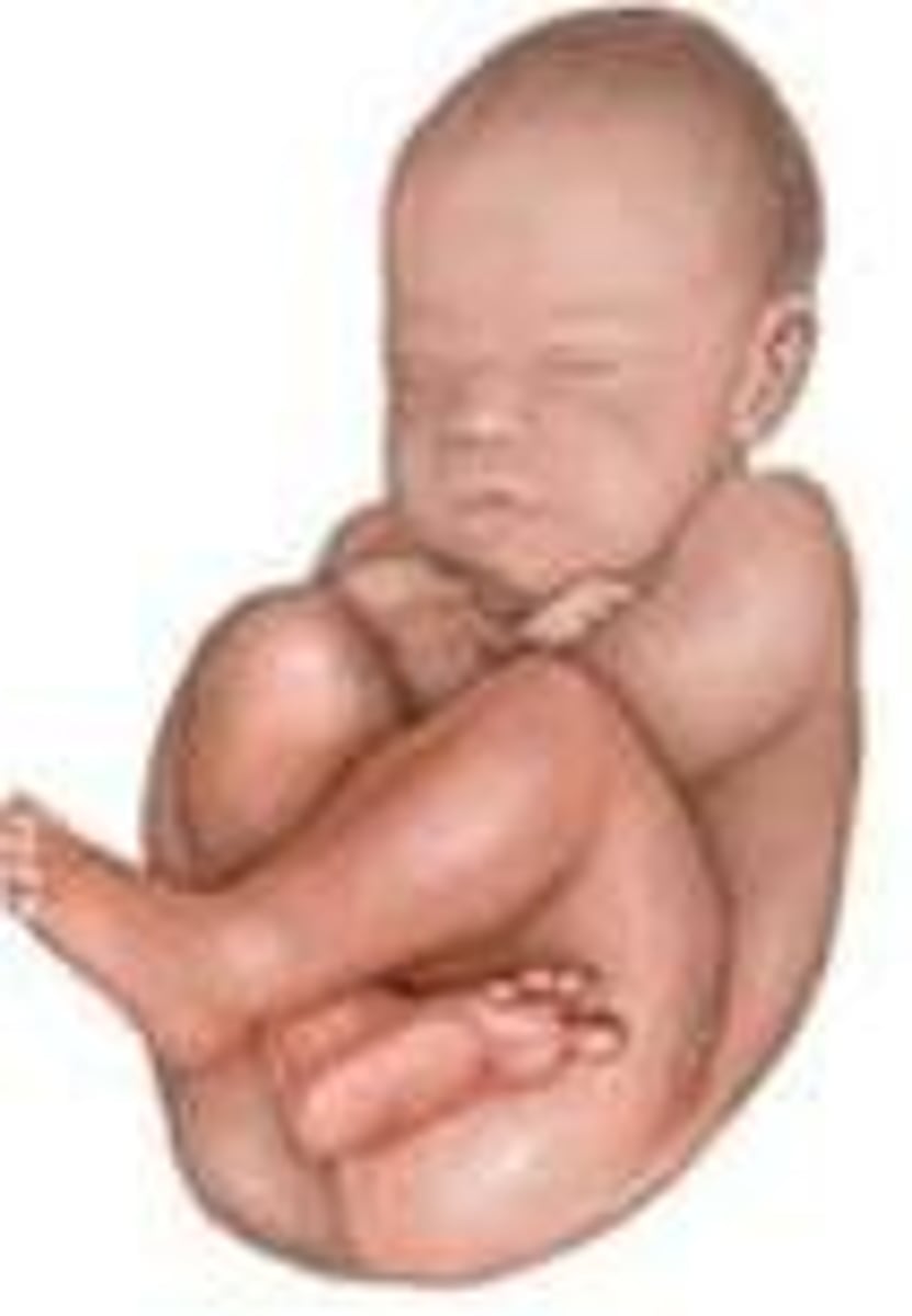 <p>-reversal of cephalic presentation</p><p>-head, knees, hips are flexed</p>