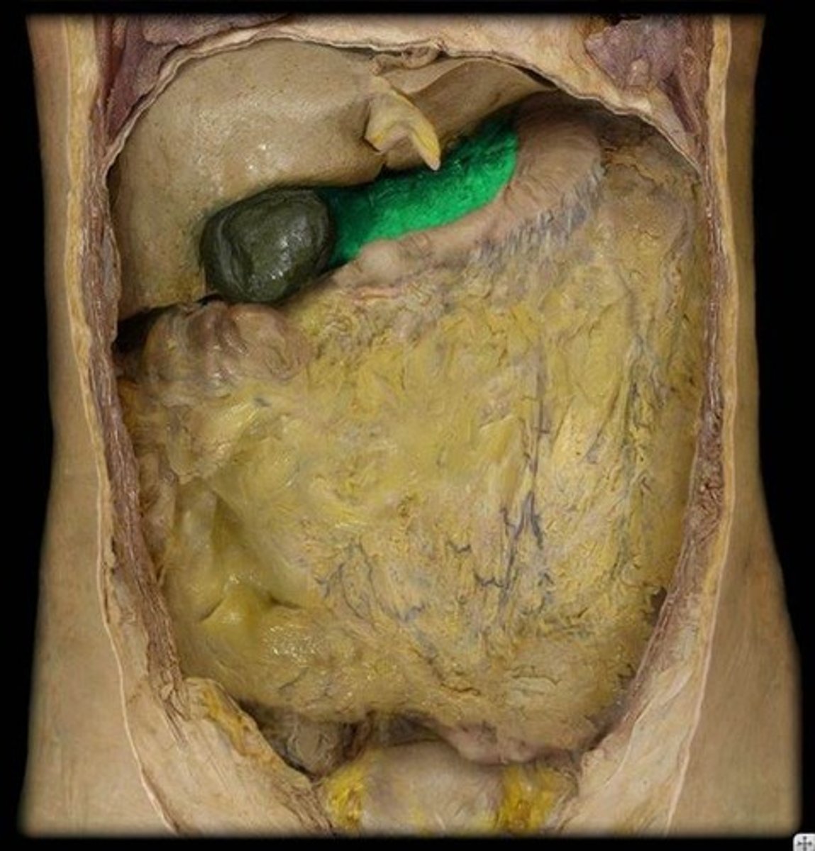<p>Name this structure extending from the lesser curvature.</p>