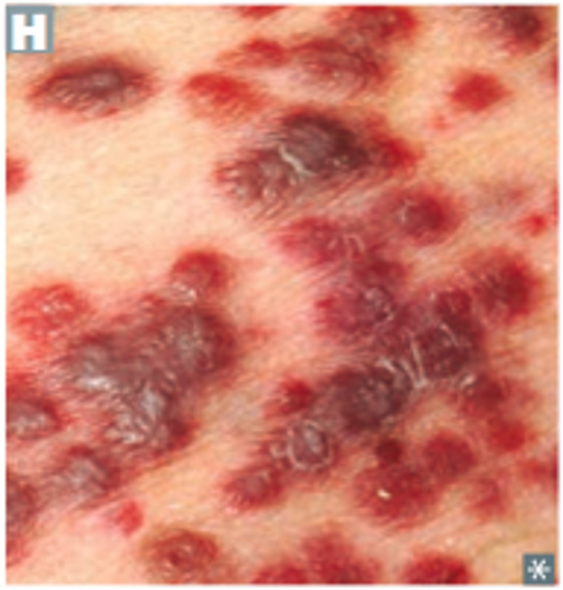 <p>Kaposi's sacroma- cancer that develops in mucous membranes (gums-making it hard to eat), skin, internal organs- dark red/purple lesions as plaques or patches (only in HIV positive patients),</p>