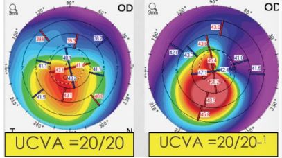 <ul><li><p>steepening of ANTERIOR corneal surface</p></li><li><p>steepening of POSTERIOR corneal surface</p></li><li><p>THINNING or INCREASE in rate of corneal thickness change from periphery &gt; thinnest point</p></li></ul>