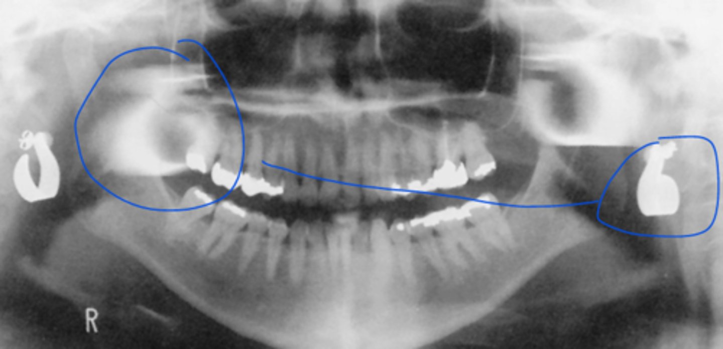 <p>The chin was slightly ___, resulting in this image</p><p>A) up</p><p>B) down</p>