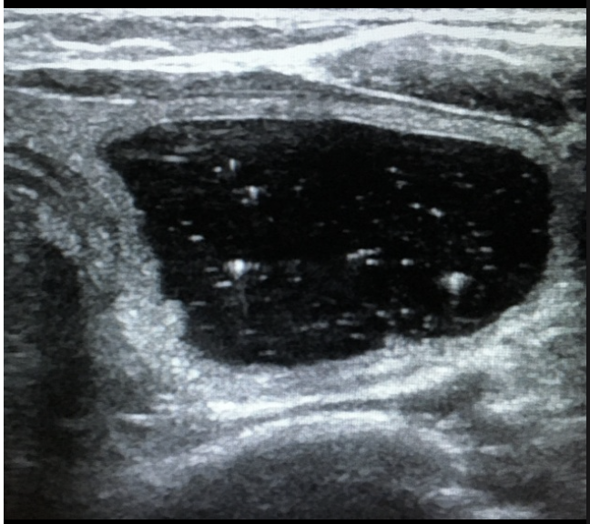 <p>What type of thyroid nodule is this - most common type, solid, well-defined, and usually non-functional?</p>