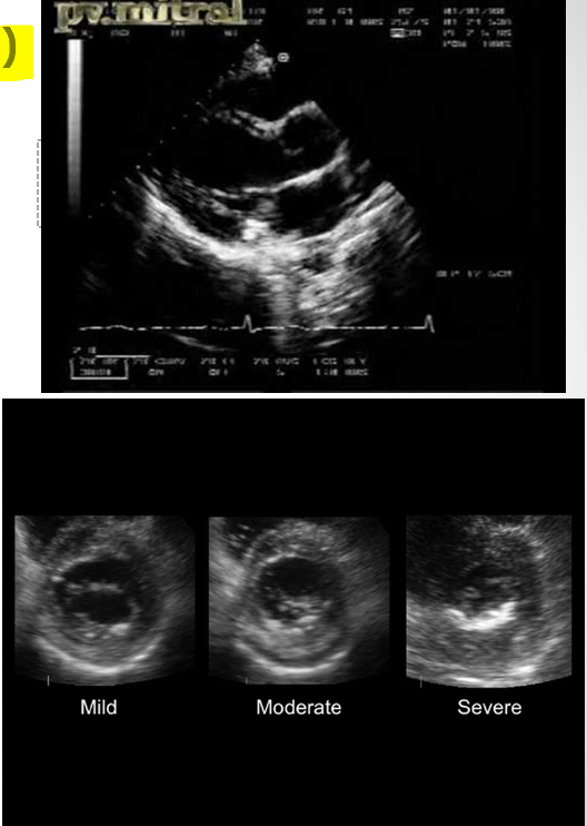 <p>posterior leaflet&nbsp;</p>