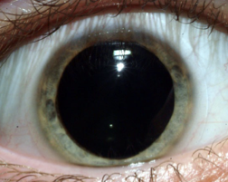 <p><span>Mydriasis</span></p>