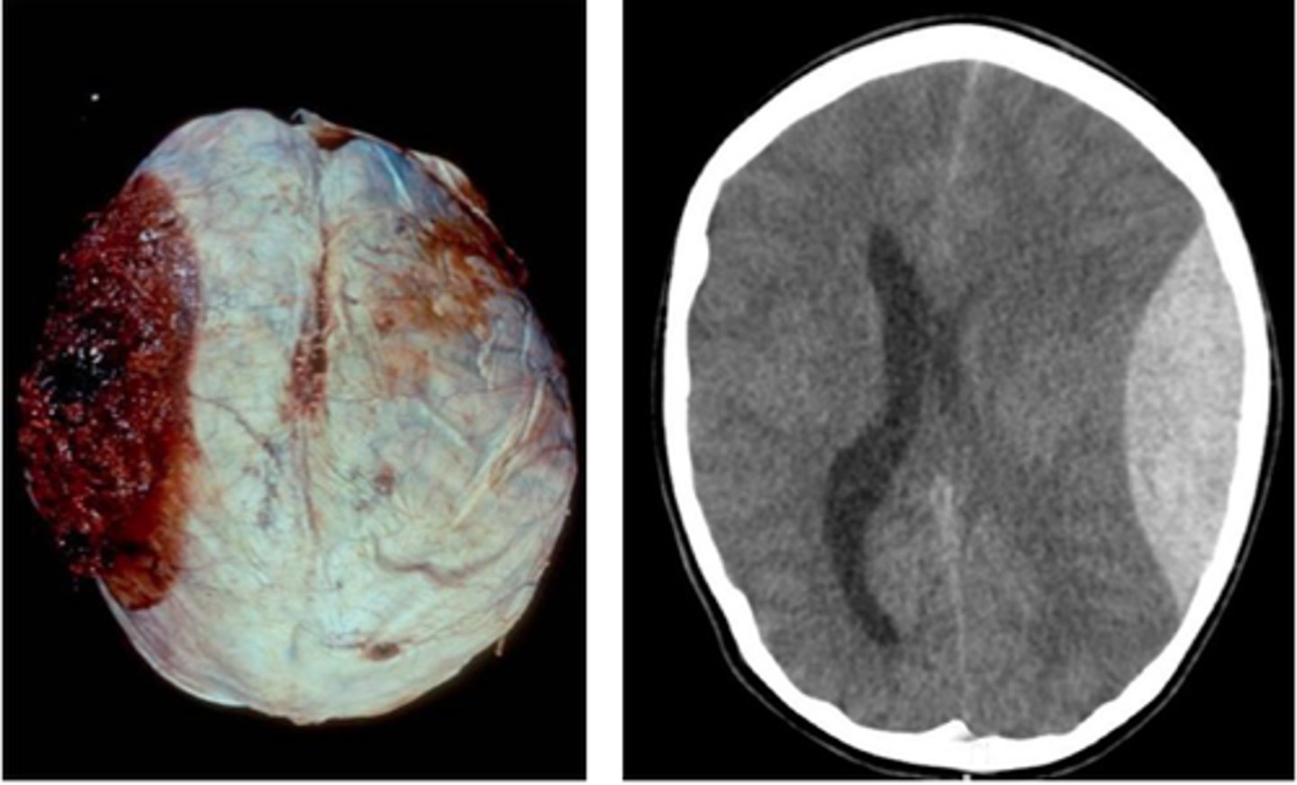 <p>Define Traumatic Vascular Injury:</p><p>-Parietal Fx</p><p>-Damage btwn dura and skull</p><p>-Damage to middle meningeal artery</p><p>-Pt experiences "lucid interval"</p>