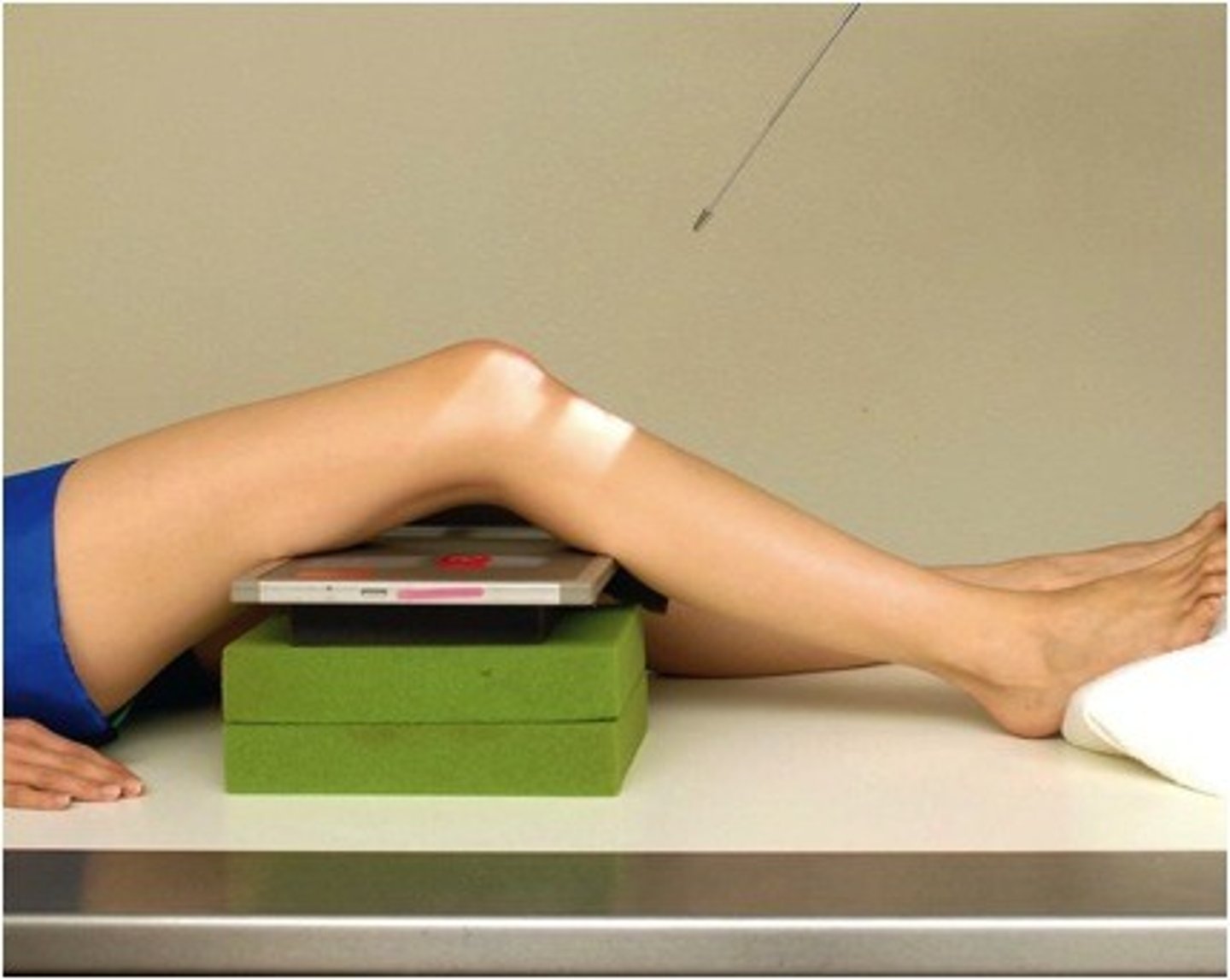 <p>AP axial projection knee of intercondylar fossa in profile</p><p>flex knee 40-45 degrees , and position support under IR as needed to place IR against posterior thigh and lower leg</p><p>CR directed perpendicular to lower leg approx. 40-45 degrees cephalad </p><p>direct CR 1/2 inch distal to apex of patella</p>