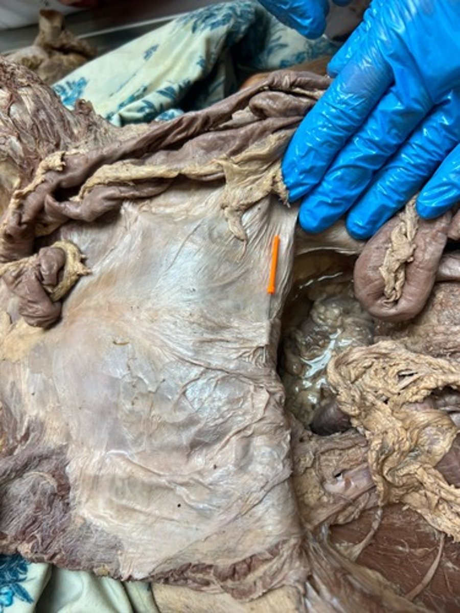 <p>median umbilical fold</p>