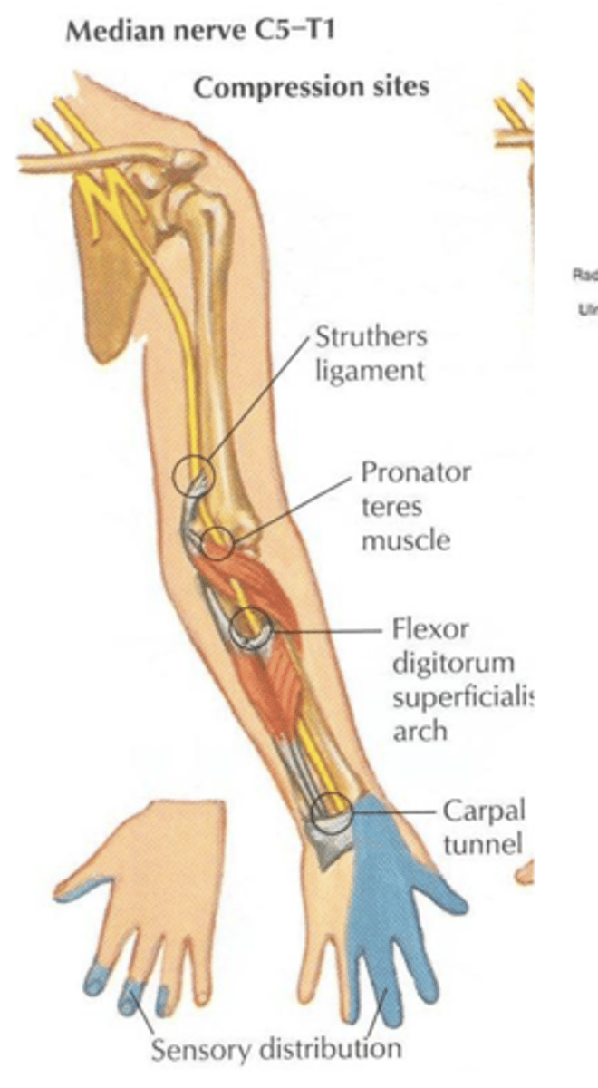 <p>-nerve loses mobility, flexibility, or becomes compressed by surrounding tissues; can cause pain and loss of function</p><p>-brain is not sending or receiving full sensations</p><p>i.e. not grasping object as strongly as should be</p><p>seen in carpal tunnel syndrome</p>