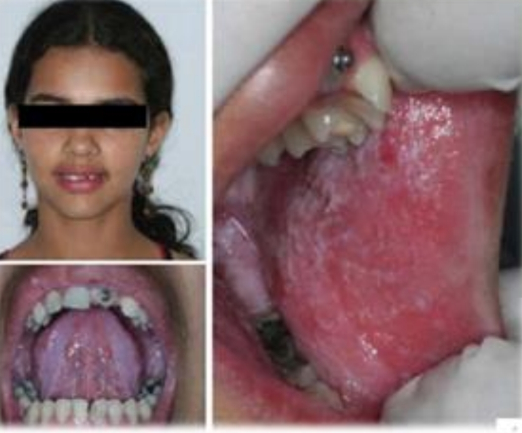 <p><strong><u>White Sponge Nevus</u></strong></p><p class="has-focus">Autosomal dominant skin disorder - keratin defect</p><p class="has-focus">Extraoral sites may be involved</p><p class="has-focus">Reaches full expression during adolescensce</p><p class="has-focus is-empty"></p><p class="is-empty has-focus"><strong>Treatment:</strong></p><p class="has-focus">None required</p><p class="has-focus">Retinoids, topical tetracyclines, systemic penicillin (partially effective)</p><p class="has-focus">Surgery most effective</p><p class="has-focus"></p><p class="has-focus is-empty"><em>DD - Leukoedema, Hereditary benign intraepithelial dyskeratosis, frictional keratosis, Hyperplastic candidiasis, Syndrome related leukoplakia</em></p>