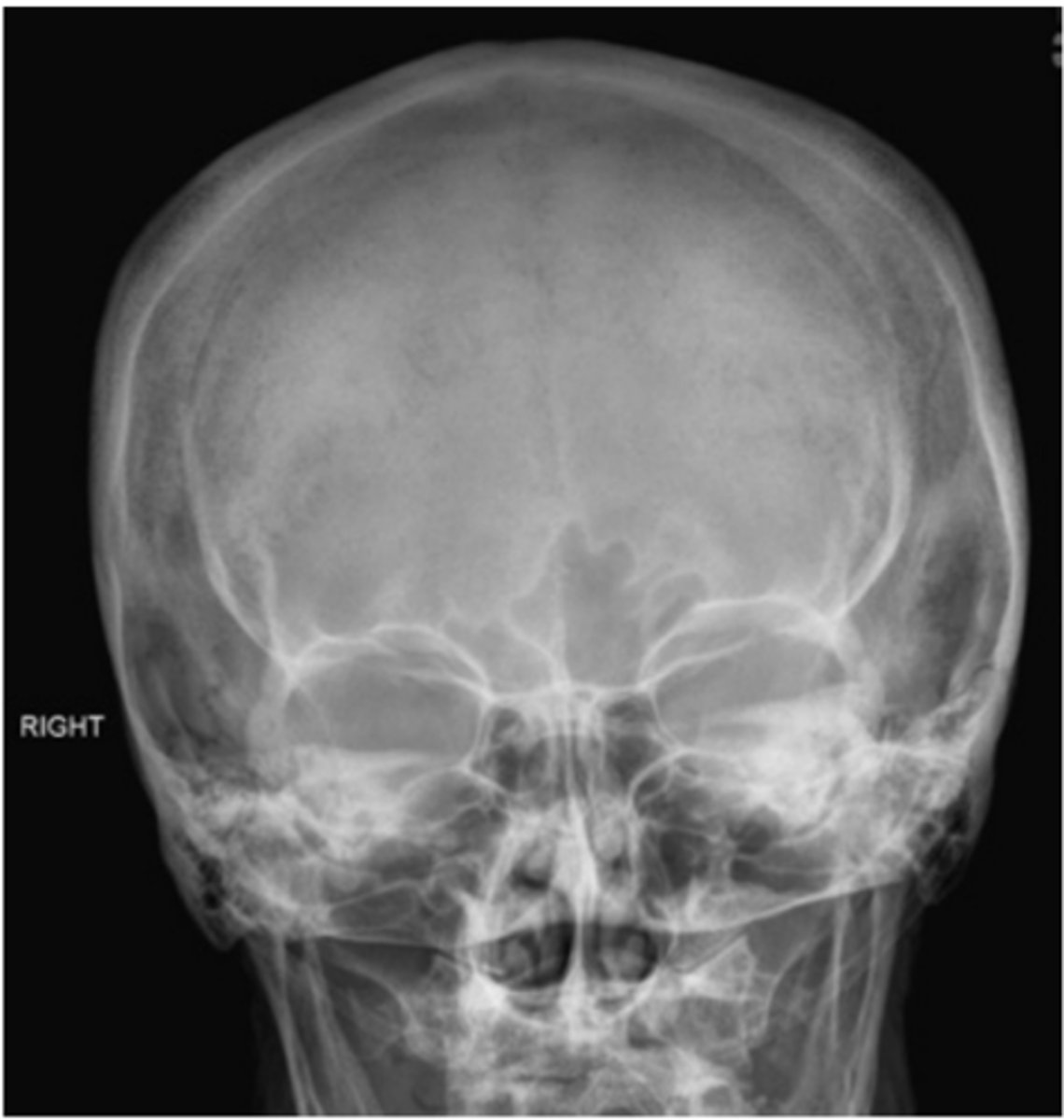 <p>-Position: no rotation or tilt is indicated by the following: equal distance from the lateral margin of the orbit to the lateral cortex of the cranium on both sides; equal distance from the MSP (identified by the crista galli) to the lateral orbital margin on both sides; superior orbital fissures symmetrically visualized within the orbits.</p>