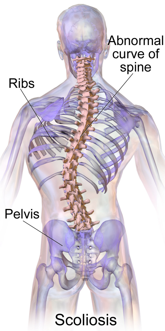 <p>Sideways curve of the spine</p>