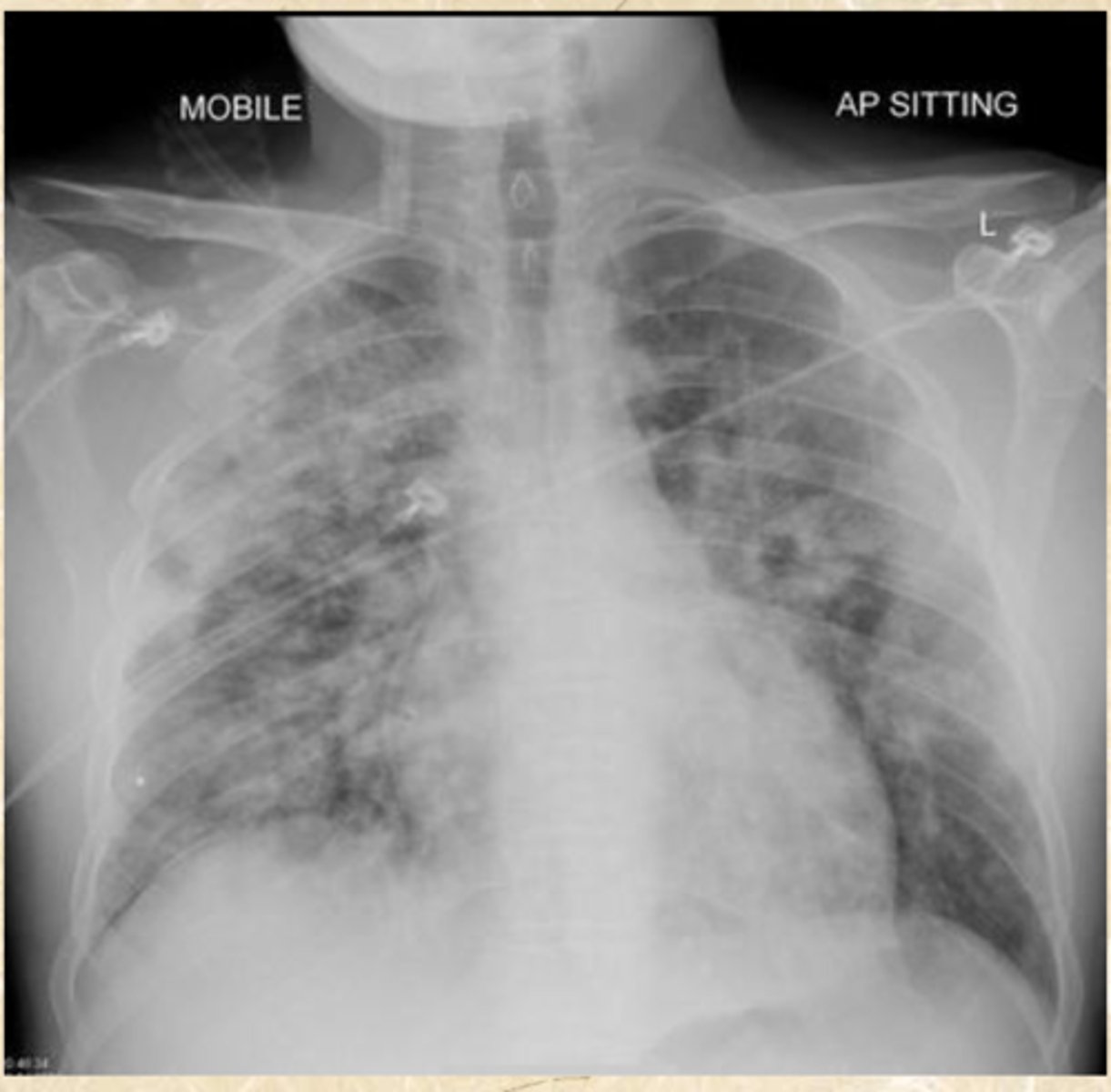 <p>What does this CXR show?</p>