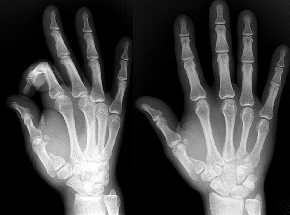 <p>fx of base of 1st metacarpal</p>