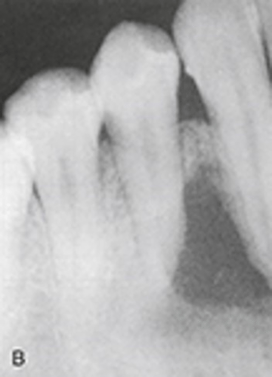 <p>May present as a multilocular radiolucency, most common on the anterior segments</p>