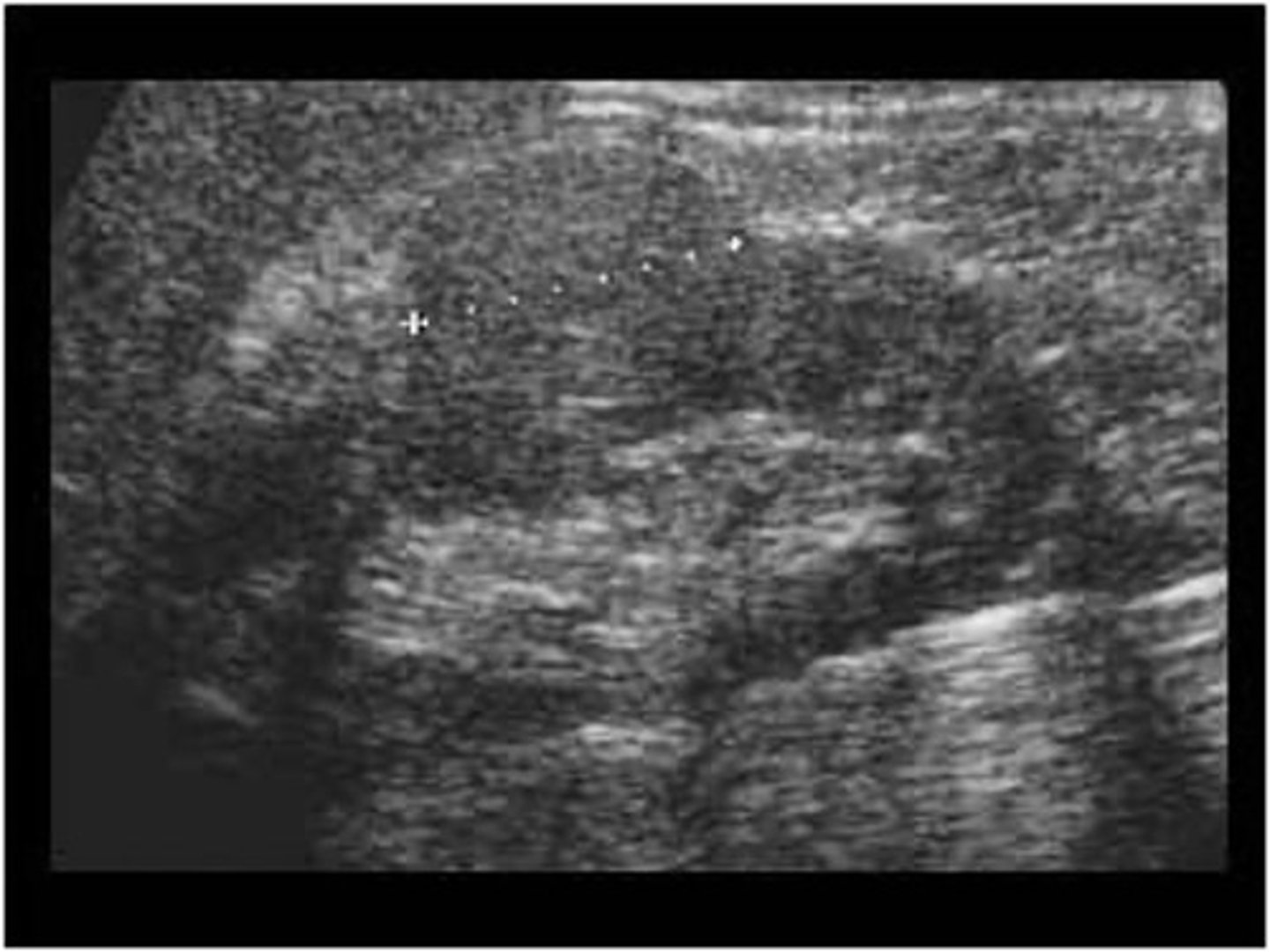 <p>What is the most common of all kidney tumors? </p>