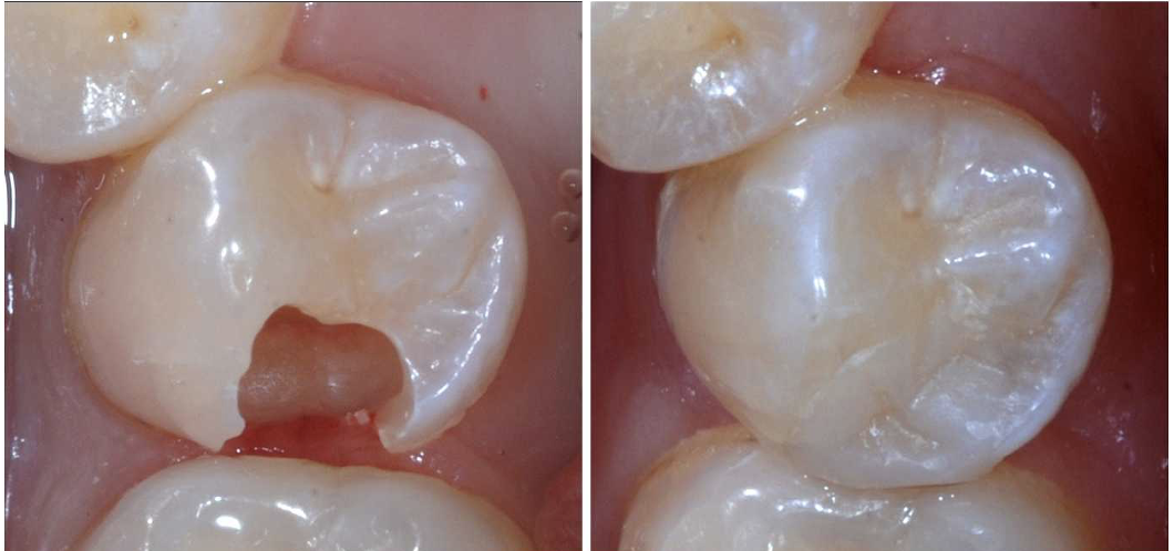 <p>classify this type of restoration</p>