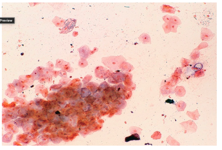 <p>A sputum specimen is submitted from a 42-year-old male.&nbsp; The gram stain (25x)&nbsp; from this specimen:</p><p></p><p>What is the next best step for this specimen?</p><p>&nbsp;</p><p>Plate the specimen only to sheep blood agar</p><p>&nbsp;</p><p>Plate the specimen only to chocolate agar</p><p>&nbsp;</p><p>Plate the specimen to sheep blood agar, MacConkey agar, and chocolate agar</p><p>&nbsp;</p><p>Reject the specimen and request a new specimen</p>