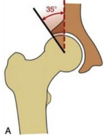 <p>formed by a vertical line through the center of the femoral head and a line connecting the center of the femoral head and the bony edge of the acetabulum </p><ul><li><p>definite dysplasia <16 degrees</p></li><li><p>possible (borderline) dysplasia 16-25 degrees</p></li><li><p>normal >25 degrees </p></li><li><p>excessive > 40 degrees </p></li></ul><p></p>