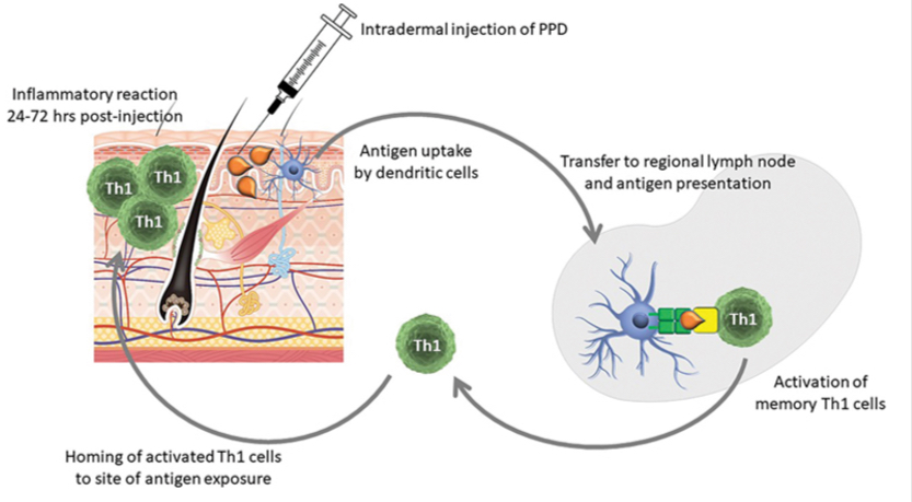 <p>Induration is the diagnostic feature (24-48 hours)</p>