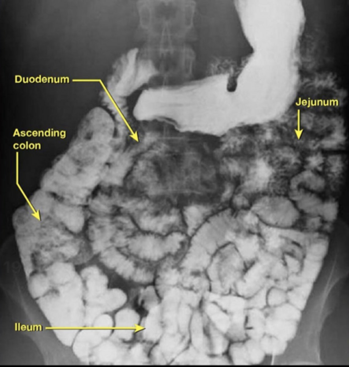 <p>Jejunum shows thick walls and numerous folds; ileum has smoother walls and fewer folds.</p>