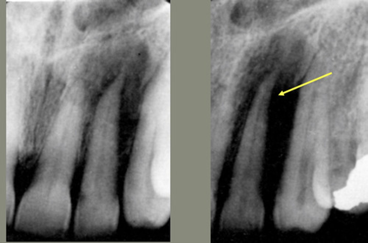 <p>Moth eaten appearance</p>