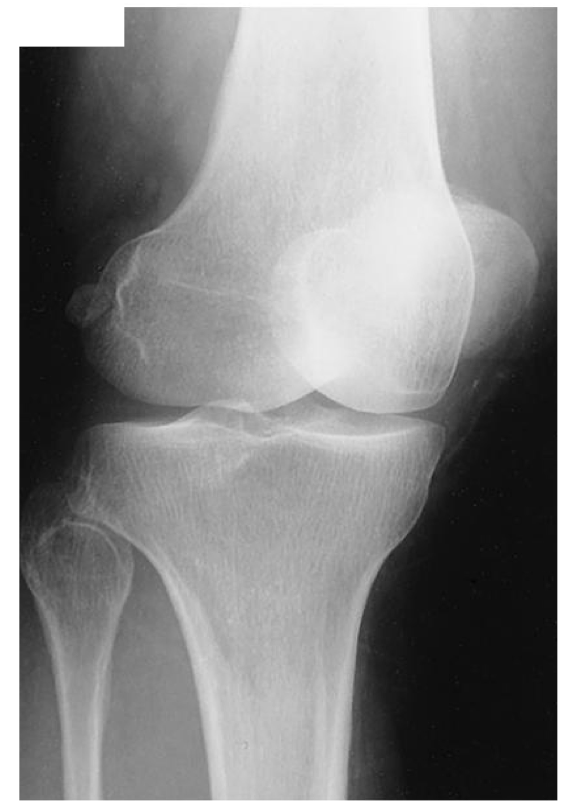 <p><span style="line-height: normal;"><span>• </span></span>Proximal tibiofibular joint open</p><p class="p1"><span style="line-height: normal;"><span>• </span></span>Demonstrates lateral femoral and tibial condyles</p><p class="p1"><span style="line-height: normal;"><span>• </span></span>Half of patella superimposed over medial femoral condyle</p>