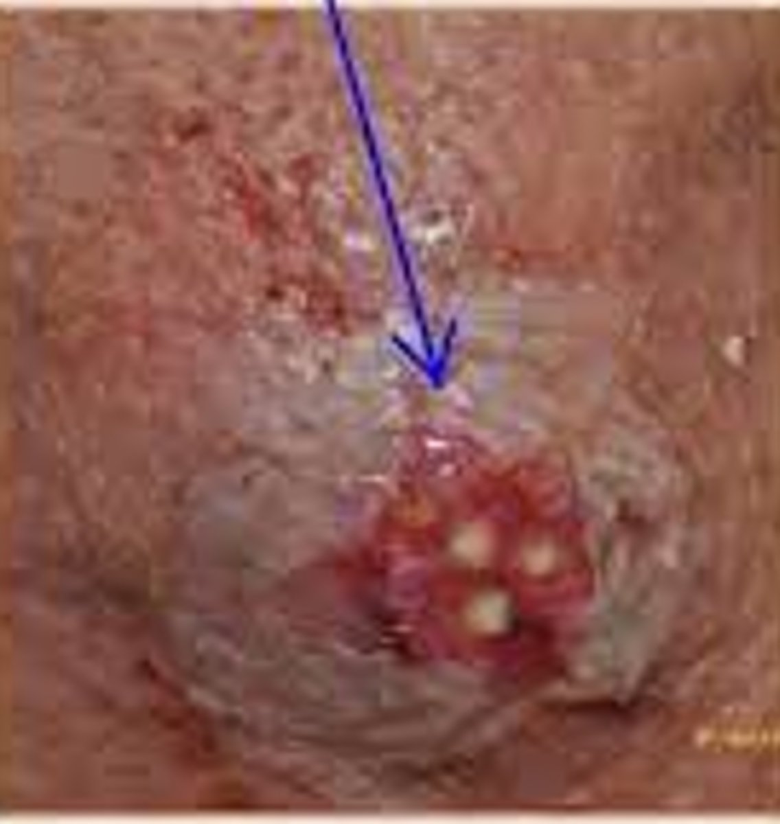 <p>cluster of boils</p>