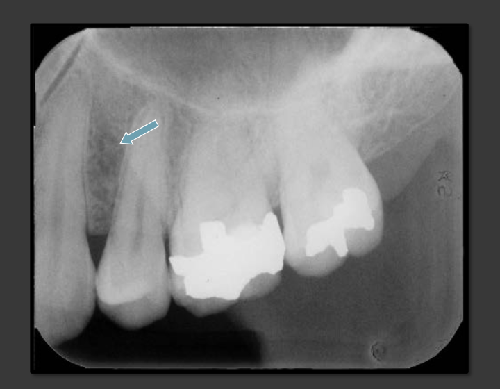 <p>This is the cheek. It is an oblique line that runs down the sides of the radiograph</p>