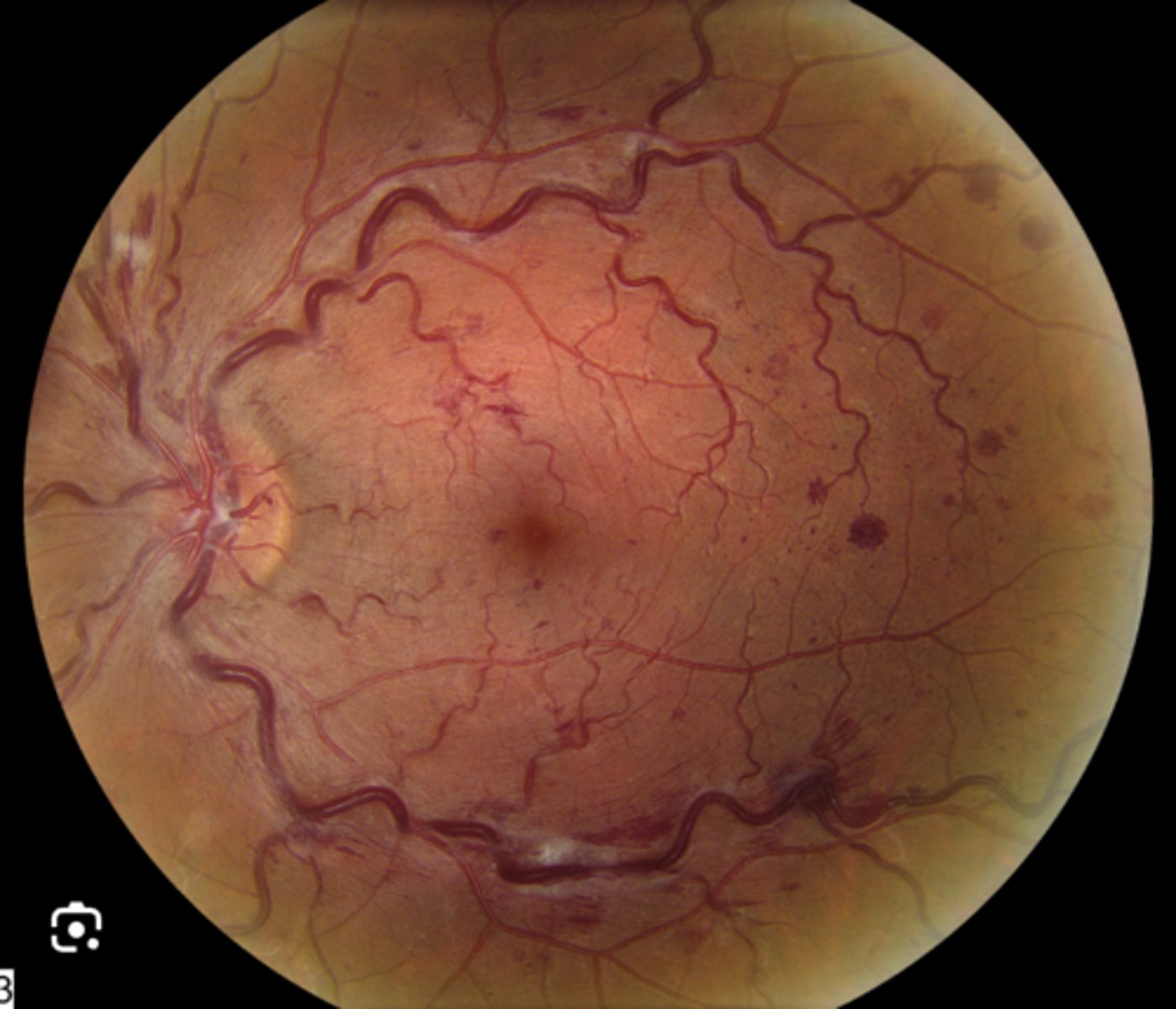 <p>Sudden painless monocular vision loss, scotomas, and blurry or distorted central vision due to macular edema. Transient visual obscurations may occur due to wax and wane symptoms. If severe, it can lead to retinal detachment and glaucoma.</p>