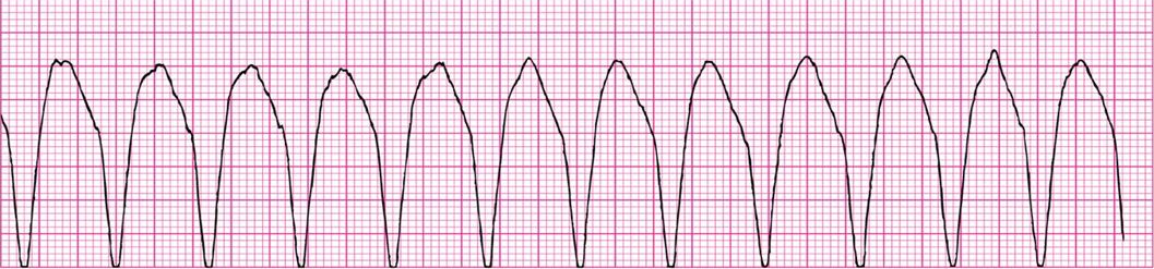 <p>WHAT IS THIS ECG READING?</p>