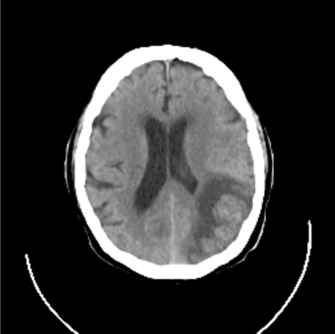 <p>What type of aphasia?</p><ul><li><p>does not understand what is said or written</p></li><li><p>unable to repeat what they hear</p></li><li><p>speech is fluent (grammatical) but disordered</p></li><li><p>can’t convert thoughts into meaningful language</p></li><li><p><strong>unaware that their responses are nonsense </strong></p></li><li><p><strong>receptive</strong></p></li></ul><p></p>