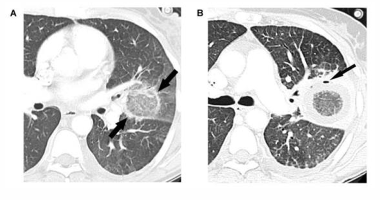 <p>-second most common</p><p>-presents with cough, dyspnea, chest pain, and severe hemoptysis</p><p>-CXR shows nodular consolidations</p><p>-compared to Aspergillus, there are often &gt;10 nodules seen in mucormycosis; other findings include pleural effusions and the “reverse halo sign”</p>