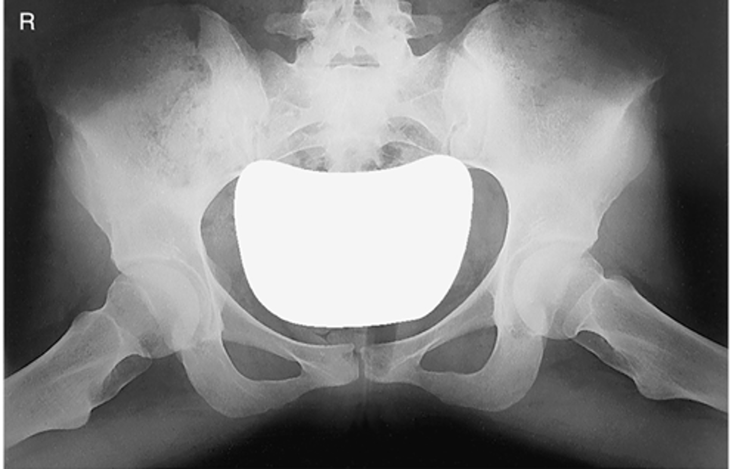 <p>ID standard bilateral pelvis projection</p>