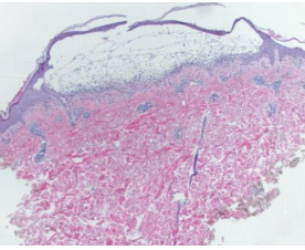 <p><span>Sub-basilar splitting</span></p>